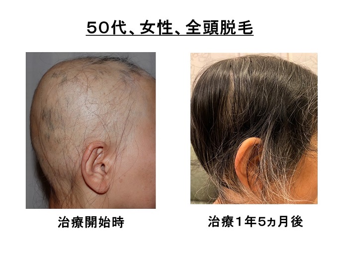 円形脱毛症　病院